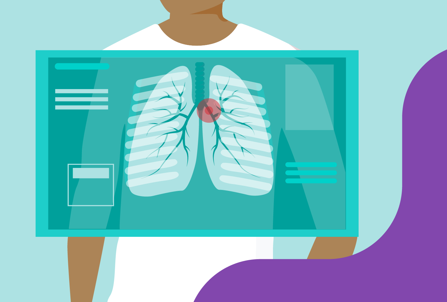 Illustration of a lung x-ray.